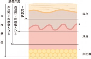 やけどの熱傷深度の度合い